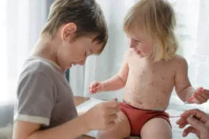 A young child in diapers who has warts is sitting next to another child indoors. 