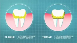 Graphic illustration showing the difference between plaque and tartar on teeth. The plaque is labeled as a colorless to pale yellow deposit, while tartar is depicted as a yellow or brown-colored deposit on the teeth near the gums.