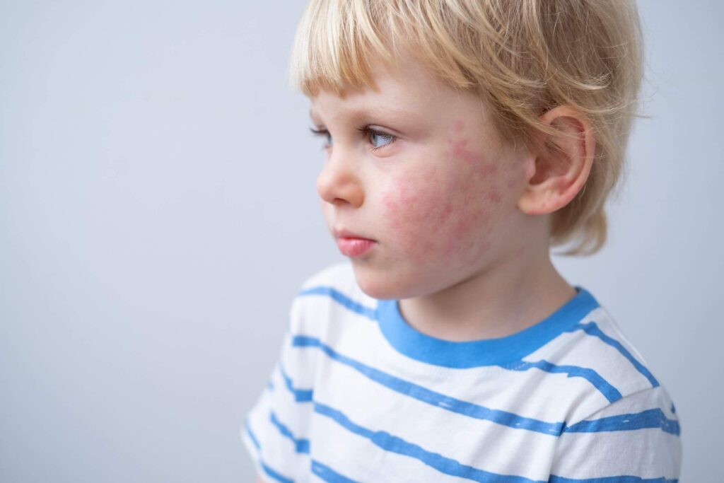 A young boy with a Allergy Skin.