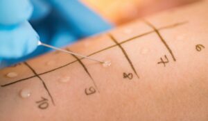  A healthcare provider performing an allergy skin test on a child