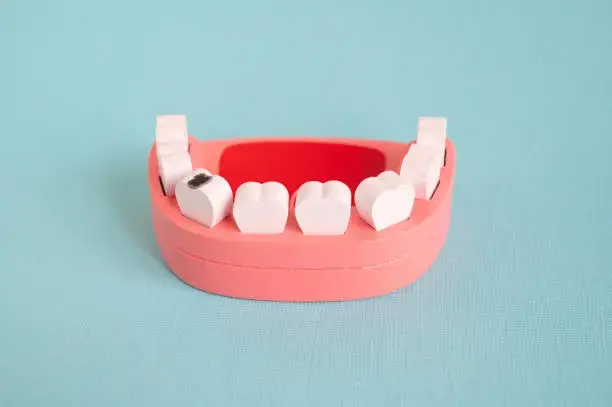 Photo for illustrating the process of pediatric cavity fillings for young patients.