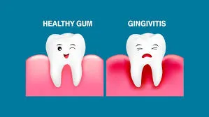 The image shows the difference between healthy gums (pink and firm) and gums with gingivitis (swollen and red).