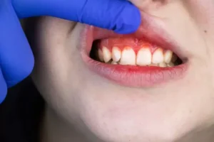 An image of a child with inflamed gums, indicating early signs of gingivitis.